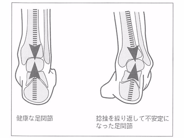 図2 -7. 足関節の捻挫による関節のゆるみ
