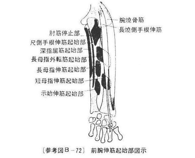 （参考図B-72）前腕伸筋起始部図示